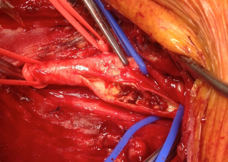 Carotid Endarterectomy Workshop